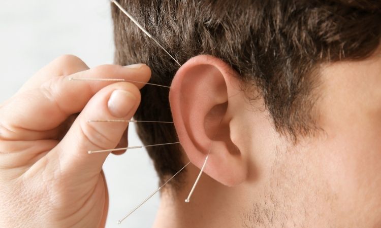 Sesión de acupuntura auricular para dejar de fumar con agujas en el pabellón de la oreja