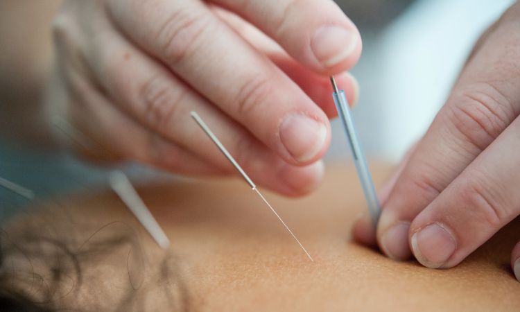 Conoce los beneficios de la acupuntura